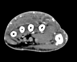 Cellulitis - CTisus CT Scan