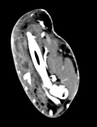 Cellulitis - CTisus CT Scan