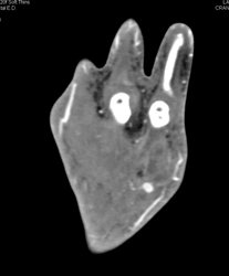 Cellulitis - CTisus CT Scan