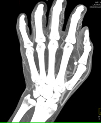 Cellulitis - CTisus CT Scan