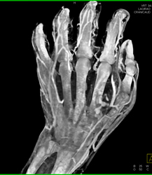 Cellulitis - CTisus CT Scan