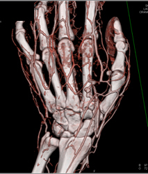 Cellulitis - CTisus CT Scan