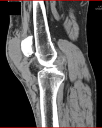 Hematoma S/p Trauma - CTisus CT Scan