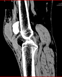 Hematoma S/p Trauma - CTisus CT Scan