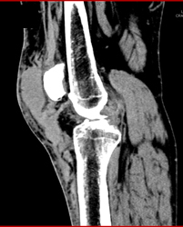 Hematoma S/p Trauma - CTisus CT Scan