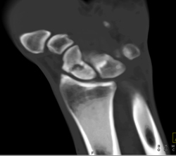 Scaphoid Fracture - CTisus CT Scan