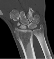 Scaphoid Fracture - CTisus CT Scan