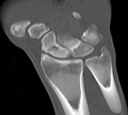 Scaphoid Fracture - CTisus CT Scan