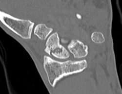 Scaphoid Fracture - CTisus CT Scan