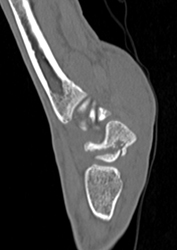 Scaphoid Fracture - CTisus CT Scan