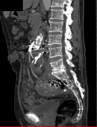 Osteomyelitis L5-s1 With Psoas Abscess - CTisus CT Scan