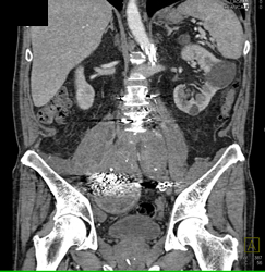 Osteomyelitis L5-s1 With Psoas Abscess - CTisus CT Scan