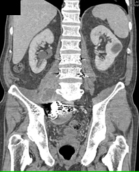 Osteomyelitis L5-s1 With Psoas Abscess - CTisus CT Scan