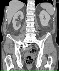 Osteomyelitis L5-s1 With Psoas Abscess - CTisus CT Scan