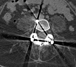 Spinal Hardware With Screw Fracture - CTisus CT Scan