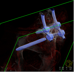 Spinal Hardware With Screw Fracture - CTisus CT Scan