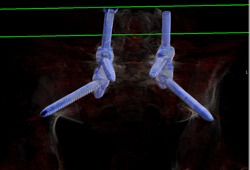 Spinal Hardware With Screw Fracture - CTisus CT Scan