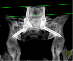 Spinal Hardware With Screw Fracture - CTisus CT Scan