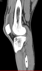 Supra-patellar Bursae Effusion - CTisus CT Scan