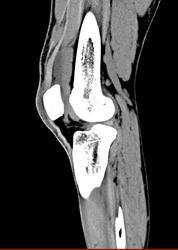 Supra-patellar Bursae Effusion - CTisus CT Scan