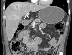 Metastases to Spine and Para-spinal Muscle - CTisus CT Scan