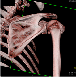 Humerus Fracture - CTisus CT Scan