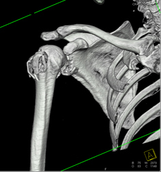 Humerus Fracture - CTisus CT Scan