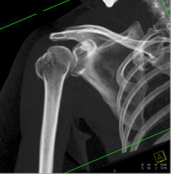 Humerus Fracture - CTisus CT Scan