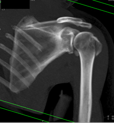 Humerus Fracture - CTisus CT Scan