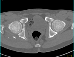 Hip Fracture Dislocation With Joint Fragment and Multiple Renderings - CTisus CT Scan