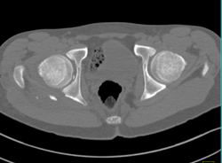 Hip Fracture Dislocation With Joint Fragment and Multiple Renderings - CTisus CT Scan