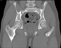 Hip Fracture Dislocation With Joint Fragment and Multiple Renderings - CTisus CT Scan