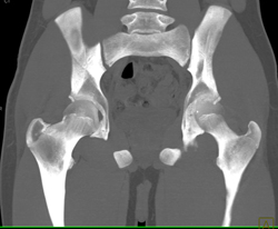 Hip Fracture Dislocation With Joint Fragment and Multiple Renderings - CTisus CT Scan