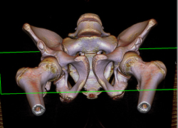 Hip Fracture Dislocation With Joint Fragment and Multiple Renderings - CTisus CT Scan