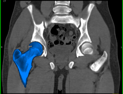 Hip Fracture Dislocation With Joint Fragment and Multiple Renderings - CTisus CT Scan