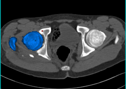 Hip Fracture Dislocation With Joint Fragment and Multiple Renderings - CTisus CT Scan