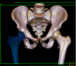 Hip Fracture Dislocation With Joint Fragment and Multiple Renderings - CTisus CT Scan