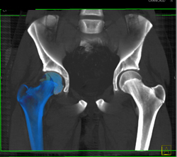 Hip Fracture Dislocation With Joint Fragment and Multiple Renderings - CTisus CT Scan