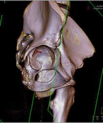 Hip Fracture Dislocation With Joint Fragment and Multiple Renderings - CTisus CT Scan