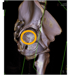 Hip Fracture Dislocation With Joint Fragment and Multiple Renderings - CTisus CT Scan