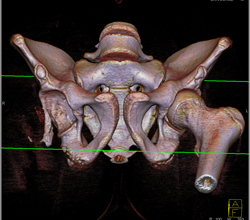 Hip Fracture Dislocation With Joint Fragment and Multiple Renderings - CTisus CT Scan