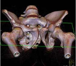 Hip Fracture Dislocation With Joint Fragment and Multiple Renderings - CTisus CT Scan