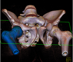 Hip Fracture Dislocation With Joint Fragment and Multiple Renderings - CTisus CT Scan