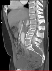 Dural Ectasia in Marfan Syndrome - CTisus CT Scan