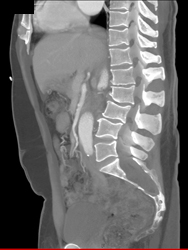 Dural Ectasia in Marfan Syndrome - CTisus CT Scan