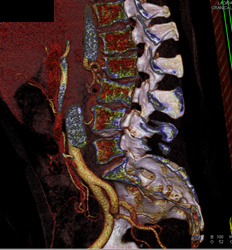 Dural Ectasia in Marfan Syndrome - CTisus CT Scan