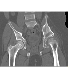 Left Hip Dysplasia Due to Earlier Avascular Necrosis (AVN). Multiple Renderings Include Bone Removal. See Full Sequence of Images - CTisus CT Scan