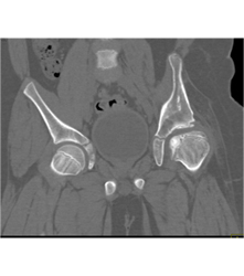 Left Hip Dysplasia Due to Earlier Avascular Necrosis (AVN). Multiple Renderings Include Bone Removal. See Full Sequence of Images - CTisus CT Scan