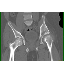 Left Hip Dysplasia Due to Earlier Avascular Necrosis (AVN). Multiple Renderings Include Bone Removal. See Full Sequence of Images - CTisus CT Scan