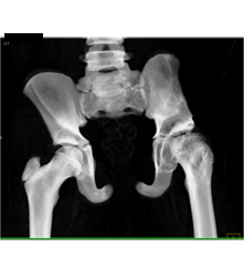 Left Hip Dysplasia Due to Earlier Avascular Necrosis (AVN). Multiple Renderings Include Bone Removal. See Full Sequence of Images - CTisus CT Scan